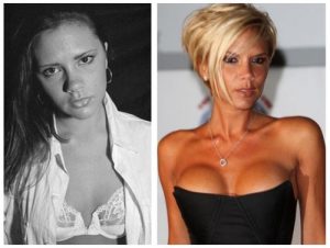 Cost of cosmetic surgery as asset